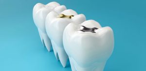 overview of dental fillings